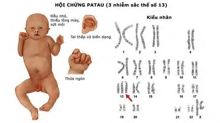 Hội chứng Patau